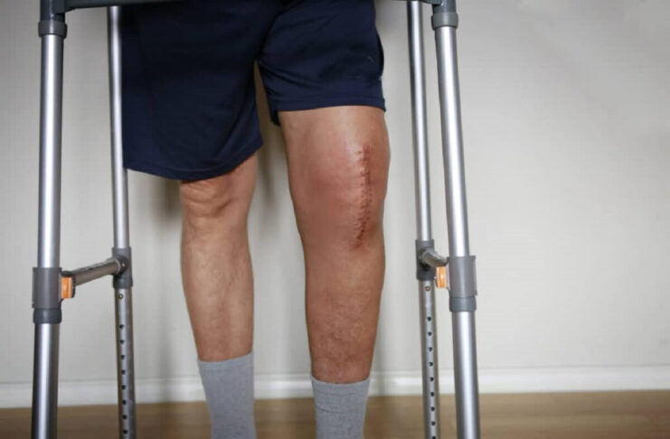 How Long Does It Take to Walk Normally After Knee Replacement